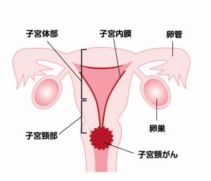 あいのり桃 子宮頸癌