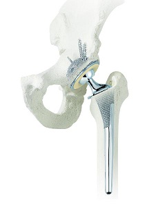 人工股関節
